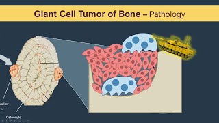 Giant cell tumor of Bone Osteoclastoma  Pathology [upl. by Paza371]