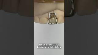 Cementing a Gold Facing dental teeth smile shorts shortvideo gold implant implants cement [upl. by Larkins]