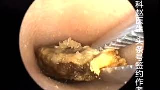 Earwax Removal Extractions From a Kid Part 1 小朋友很坚强，还有一侧耳朵周一再来取出 外耳道挖耳屎清理 耳垢 耳垢 [upl. by Newbold530]