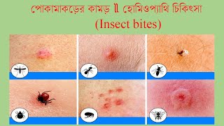 পোকার কামড়ে কি কি করণীয় ও কি ওষুধ প্রয়োজন Insect bite Homeopathic treatment and medicine [upl. by Yeruoc]