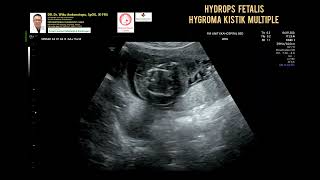 Hydrops Fetalis Hygroma Cystic [upl. by Inoy]