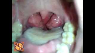 amandel terbesar  the largest tonsils [upl. by Avra662]