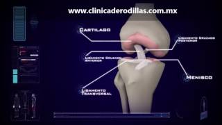 Clinica de Rodillas  Ruptura Parcial Ligamento Cruzado Anterior LCA  México [upl. by Felder]