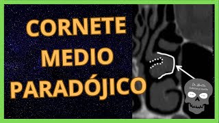 CORNETE Medio PARADÓJICO 👉Así se ve en TOMOGRAFÍA [upl. by Atiuqa48]