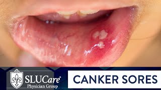 Determining Causes amp Treatment for Canker Sores  SLUCare Otolaryngology [upl. by Delmar]