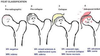 What is avascular necrosis [upl. by Ruomyes]