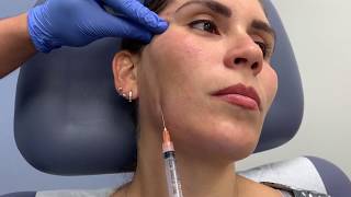 Sculptra treatment for correcting facial volume loss and antiaging by Dr Shaun Patel in Miami FL [upl. by Adnamma]