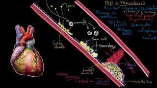 Khan Academy  Atherosclerosis in Heart Disease [upl. by Terag]