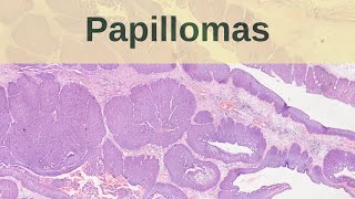 What are Papillomas  Pathology mini tutorial [upl. by Anrahs]