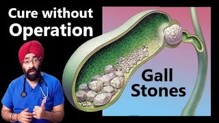 How do I treat Gall bladder stones without surgery  DrEducation Hindi  Eng [upl. by Sherburn396]