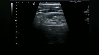 Ultrasound video showing subhepatic appendicitis [upl. by Garate]