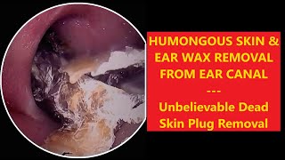 HUMONGOUS SKIN amp EAR WAX REMOVAL FROM EAR CANAL  EP1 relaxing satisfying asmr earwax [upl. by Ardnatal940]