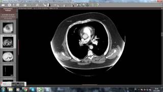 CT Computertomographie Lungenembolie Videoanalyse [upl. by Zilla]