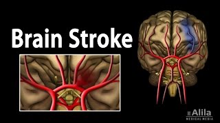 Brain Stroke Types of Causes Pathology Symptoms Treatment and Prevention Animation [upl. by Anaeirb264]