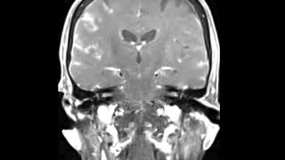 Leptomeningeal Carcinomatosis [upl. by Peirce]