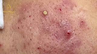 Treatment of pustules and inflammatory acne 84  Loan Nguyen [upl. by Felipa]