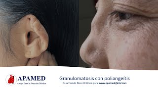 Granulomatosis con poliangeítis Granulomatosis de Wegener y vasculitis asociadas a ANCA [upl. by Tiphany966]