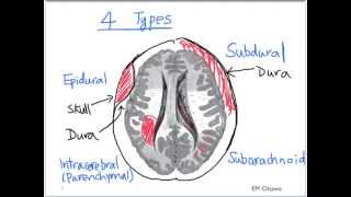 Intracranial Bleed  Part 1 [upl. by Barret]