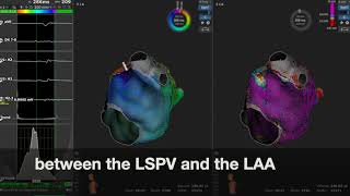 Atypical flutter Rhythmia [upl. by Moretta]