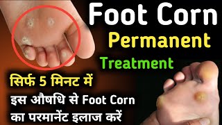 Footcorn Permanent Treatment  Foot corn Permanent Solution  footcorn  footcorn deshi ilaj [upl. by Solange]