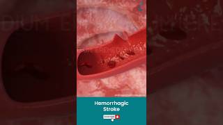 Brain Bleed Hemorrhagic Stroke ↪ 3D Medical Animation Shorts Brain HemorrhagicStroke [upl. by Gitlow]