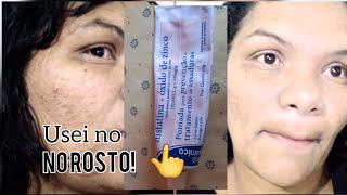 Resultado de 1 Mês Usando NistatinaÓleo de Rosa Mosqueta Pra Clarear Melasma e Manchas da Pele Acne [upl. by Stelmach430]