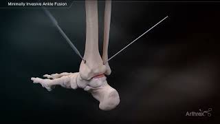 Arthrodèse de la cheville  Chirurgie arthrose tibiotalienne  Dr Simon Tournemine [upl. by Mcmullan445]