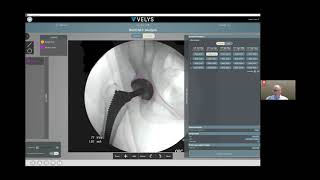 VELYS™ Hip Navigation The Power of DataDriven Decisions Using Fluoroscopy [upl. by Zebadiah]