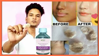 Glycerin  Uses of glycerin for mens  Hindi [upl. by Enelrad994]