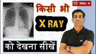 XRay को कैसे देखते है  सबसे सरल तरीका  How to read Chest XRay Most easy method [upl. by Karita]