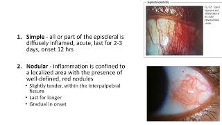 EPISCLERITIS AND SCLERITIS [upl. by Sirotek398]