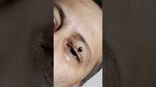 Botfly Maggot Removal spa doctor satisfying pimple removal [upl. by Gilson]