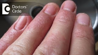 How to treat Contact Dermatitis on fingertips  Dr Aruna Prasad [upl. by Lezned922]