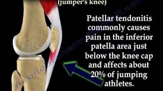 Patellar Tendonitis Jumpers Knee  Everything You Need To Know  Dr Nabil Ebraheim [upl. by Krishnah]