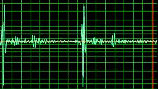 Aortic Regurgitation Ejection Systolic Murmur normal speed [upl. by Rowland]