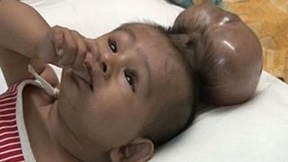 Baby Born With Two Heads  Extraordinary Birth [upl. by Hares]