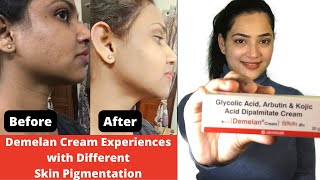 Demelan Cream Experiences with Different Skin Pigmentation  Demelan cream before and after pictures [upl. by Rehc]