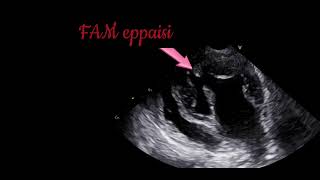 Myxomatous MitralValve Prolapse [upl. by Merrily]