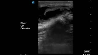 Elbow Ultrasound Olecranon Bursitis Long Axis [upl. by Peacock]