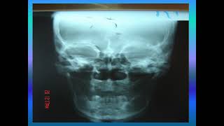 Odontogenic Tumor and Odontoma  DrHaiderDakheel  Oral Surgery [upl. by Ahtelrac]