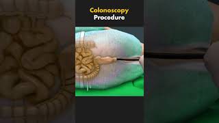 How Colonoscopy is performed 3dmedicalanimation ytshorts medical3danimation [upl. by Chrisse]