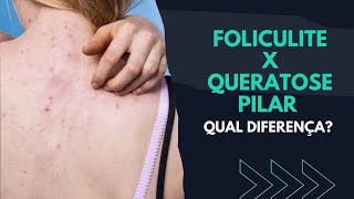 Foliculite x Queratose Pilar QUAL DIFERENÇA  DESCUBRA [upl. by Reinwald]