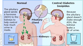 Central Diabetes Insipidus [upl. by Schell465]