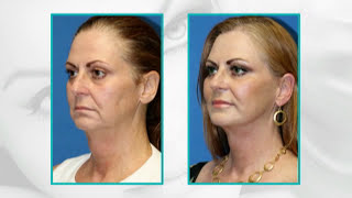 Facial Plastic Surgery Before and After 15 Years Younger Facelift facial fat transfer eyelid [upl. by Matt883]