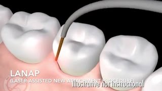 How Does Laser Surgery Work Treat Gum Disease  LANAP [upl. by Adnirol]