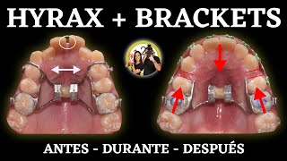 Proceso 𝗠𝗘𝗦 𝗮 𝗠𝗘𝗦  HYRAX  BRACKETS  Tratamiento ORTODONCIA [upl. by Sailesh]