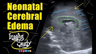 Neonatal Cerebral Edema  Ultrasound  Case 278 [upl. by Shadow]