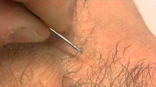 How to remove an ingrown hair [upl. by Tnafni]