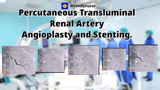 renalartery RenalArteryStenting cathlab angioplasty Procedure on Renal Artery Stenting [upl. by Indihar]