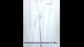 Así es una Arterialización Venosa cirugiavascular vasculardisease vascularhealth [upl. by Aryt]